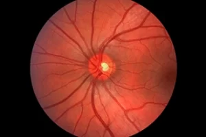 Netzhaut